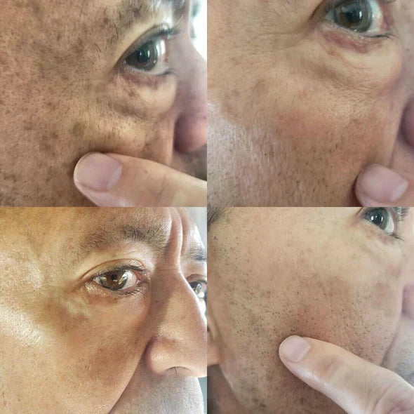 ✨Fast Dark Spot Remover-AQA™  Melanin Correcting Facial Serum(🔥Last Day Promotion 60% OFF)