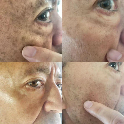 ✨Fast Dark Spot Remover-AQA™  Melanin Correcting Facial Serum(🔥Last Day Promotion 60% OFF)