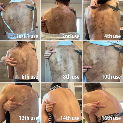 ✨Fast Dark Spot Remover-AQA™  Melanin Correcting Facial Serum(🔥Last Day Promotion 60% OFF)