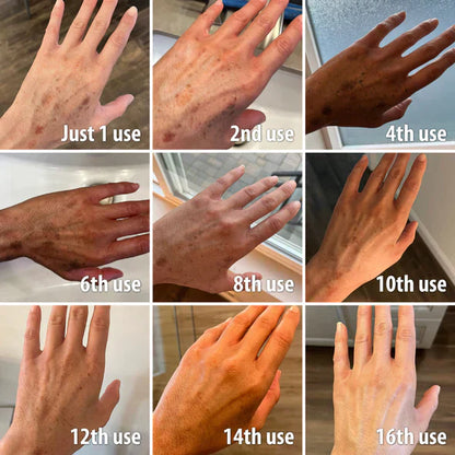 ✨Fast Dark Spot Remover-AQA™  Melanin Correcting Facial Serum(🔥Last Day Promotion 60% OFF)